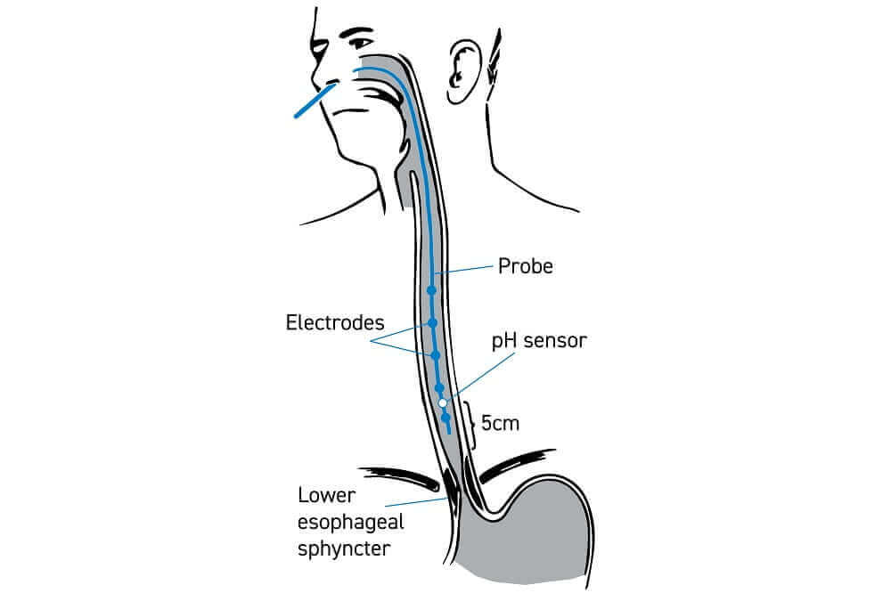 Diagram of catheters in the nasal cavity to the lower oesophageal sphincter